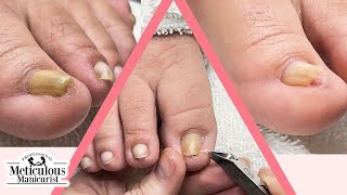 👣 Ingrown Toenail Pedicure👣