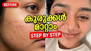 ‼️🔥 Get Rid of Facial Pimples and Comedones | Step By Step Skincare Routine screenshot 3