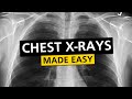 Chest X Rays Made Easy! (Learn in 10 Minutes!) | PostGradMedic