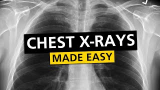 Chest X Rays (CXR) Made Easy! - Learn in 10 Minutes! screenshot 4