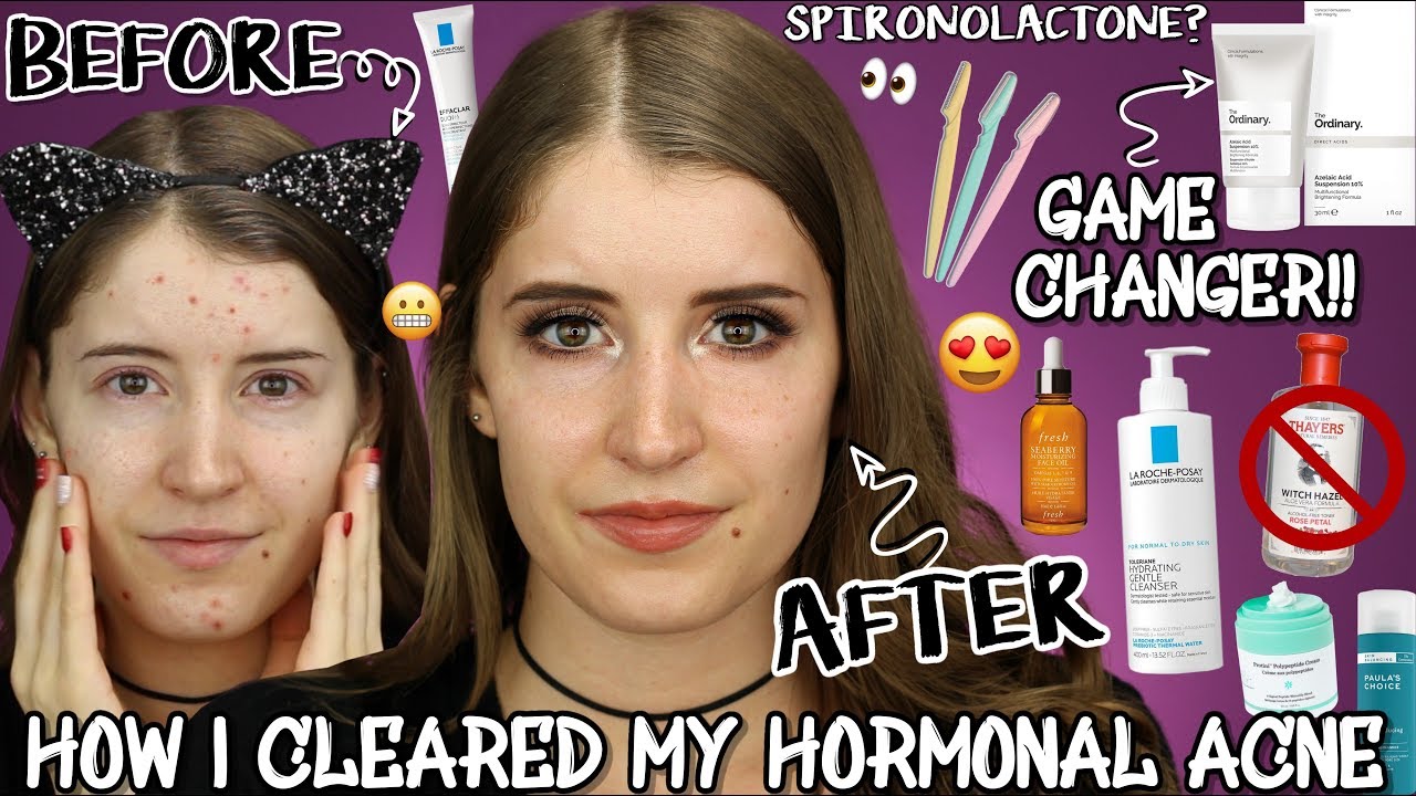 HOW I CLEARED MY SKIN FAST! HORMONAL ACNE SKINCARE ROUTINE - YouTube