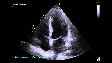 Apical 4 chamber view of a normal heart