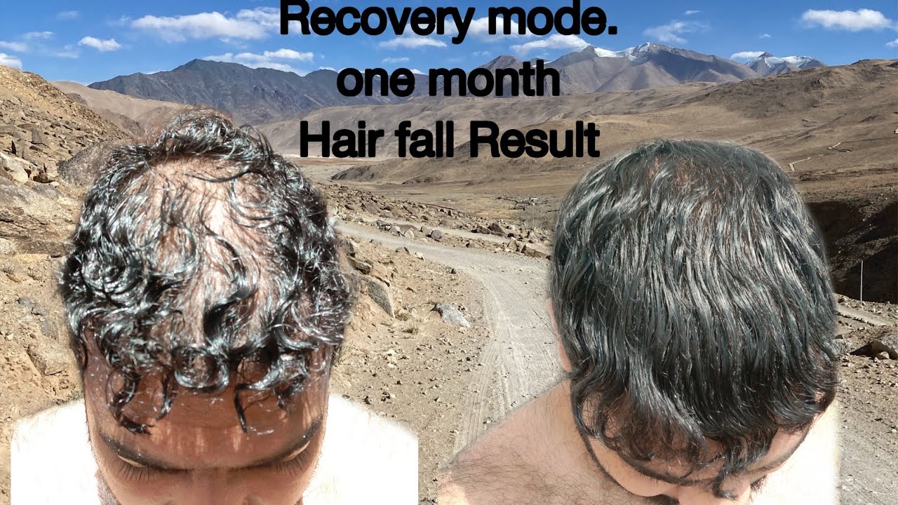 Telogen Effluvium Hair Loss Recovery Mode YouTube Telogen Effluvium Hair Loss Recovery Mode YouTube