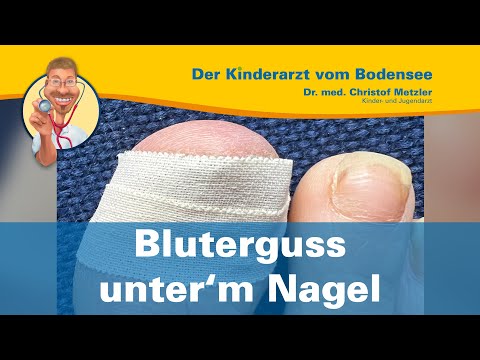 Video: Wie sticht man eine heiße Nadel durch einen Nagel?