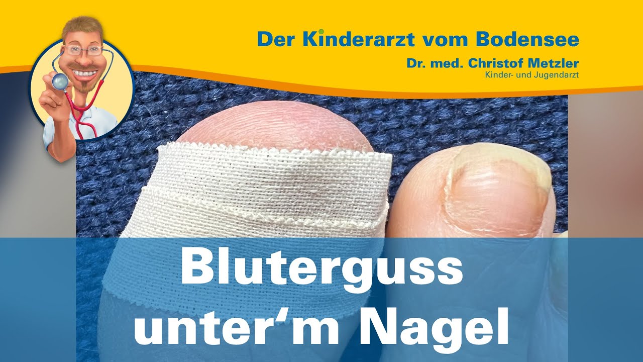 Was Kann Man Gegen Einen Bluterguss Machen www.youtube.com