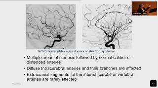 CNS vasculitis