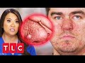 Dr Lee Treats An Autistic Patient With &quot;Wart-Like Bumps&quot; On His Face | Dr. Pimple Popper