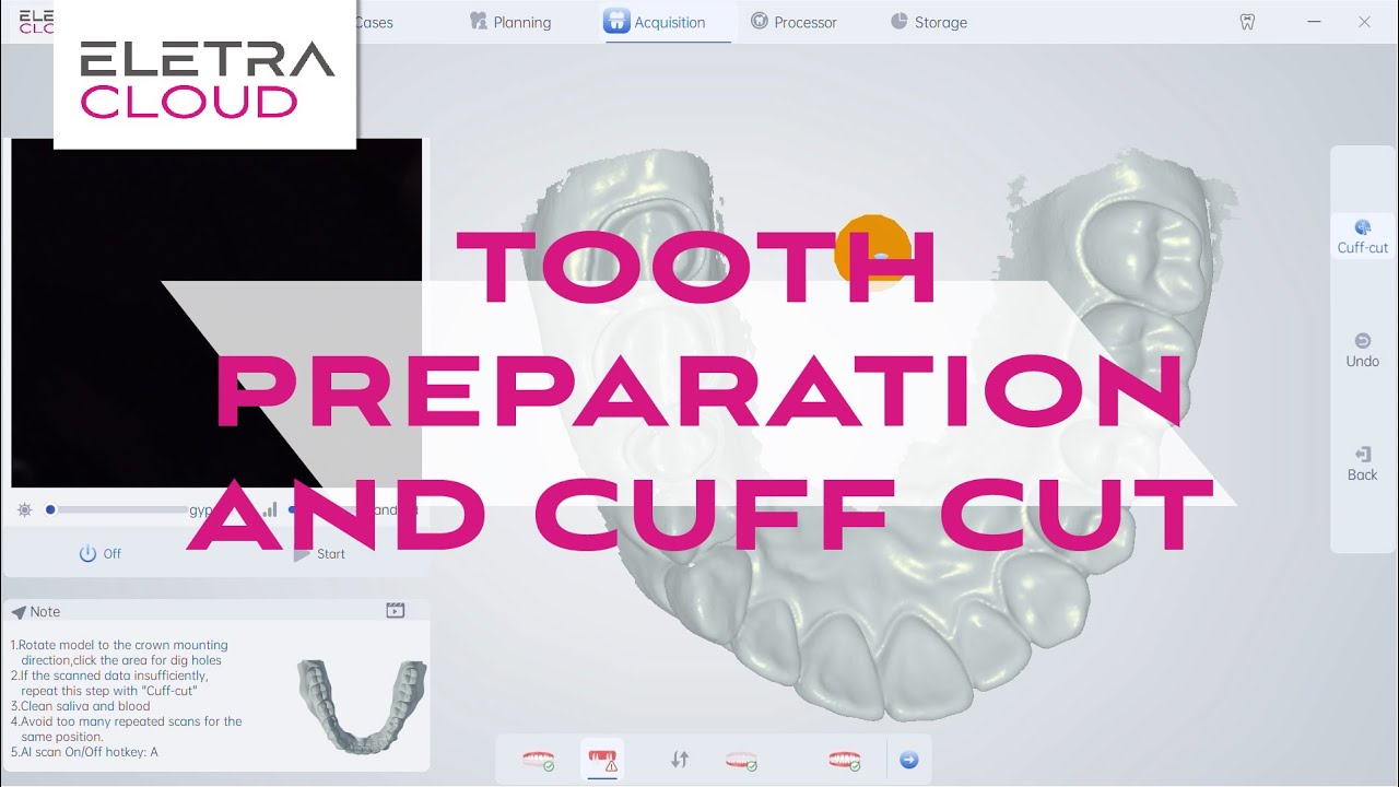 Smartooth Scanner ELETRA SMART Intraoral Scanner Training | Tooth Preparation and Cuff ...