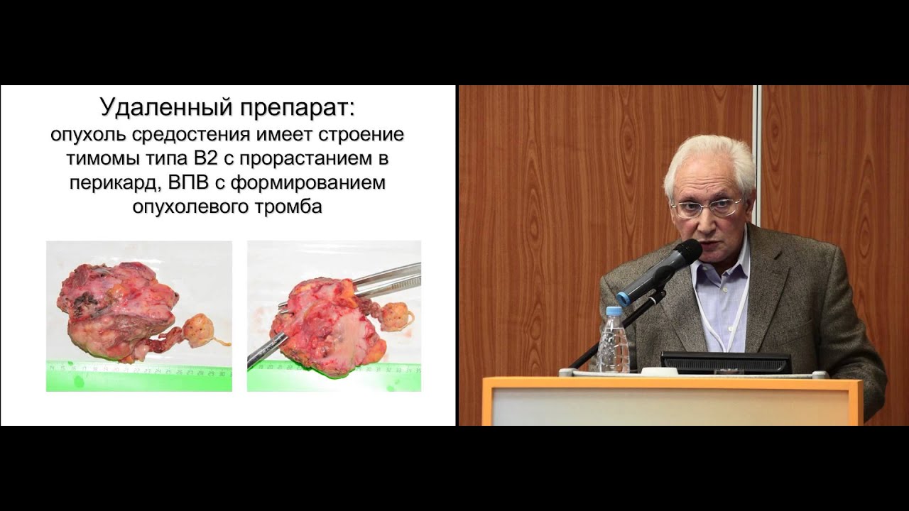 Опухоли средостения. Современные хирургические технологии