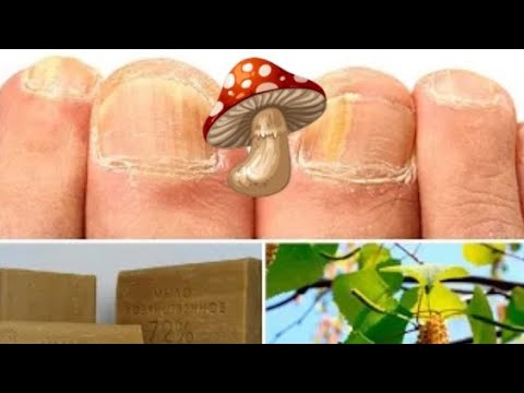 Сильное Мыло от Грибка Ног🔥 Простое и дешевое средство вам поможет ...