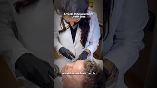 Ameela® Polynucleotides Under Eyes @house-of-saab-clinic #londonaesthetics #londonbeauty #london #uk