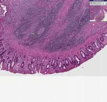 Histopathology Colon--Ulcerative colitis, carcinoma, atypia
