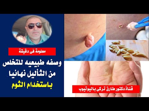 وصفه طبيعيه للتخلص من الثأليل نهائيا وبسرعه باستخدام الثوم