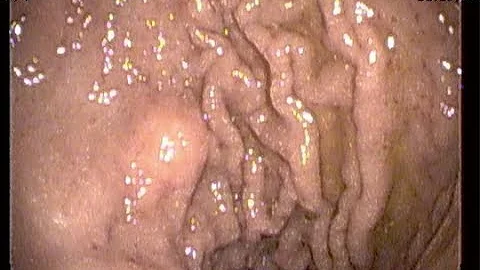 檢查發現胃腸道基質瘤 需手術切除嗎？ - 天天要聞