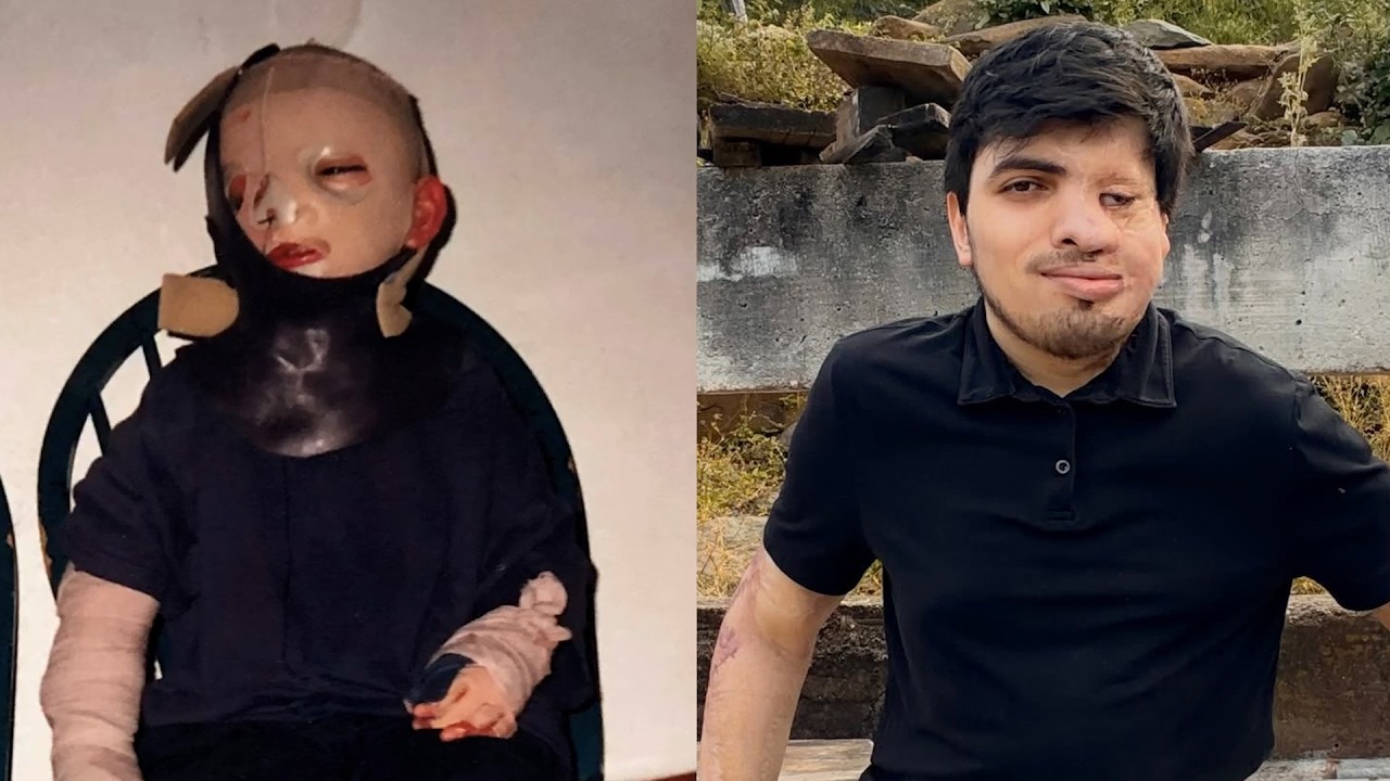 Texas Man Survives Childhood Fire That Burned 65% of His Body