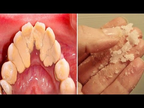 How to Get Rid of Plaque  - Home Remedies for Plaque and Tartar