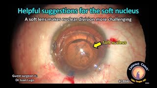 CataractCoach™ 1866: helpful suggestions for the soft nucleus screenshot 2