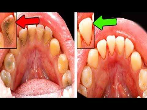 Effective remedy to turn yellow teeth two parallel white teeth permanently In just 2 Minutes