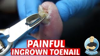 EXTREME PAINFUL INGROWN TOENAIL REMOVALDID IT HURT TO REMOVE IT?