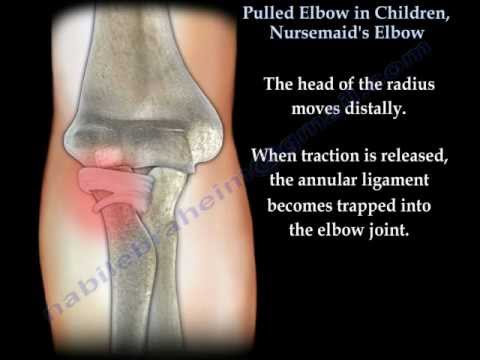 Pulled Elbow In Children, Nursemaid&rsquo;s Elbow - Everything You Need To Know - Dr. Nabil Ebraheim