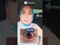 د فاطمه غلوش ضعف النظر الليزك نزيف الملتحمه عيون قطور محافظة الغربية 