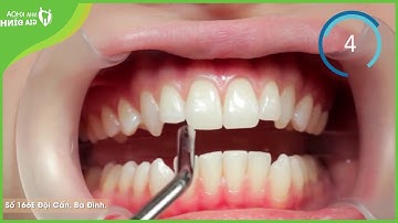 Cận cảnh quy trình niềng răng trong suốt Invisalign