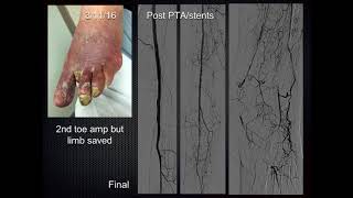 Extreme Pedal and Digital Access – How? - Peter Soukas, MD