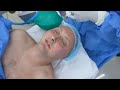 American Man going under Anesthesia (Cosmetic Surgery)