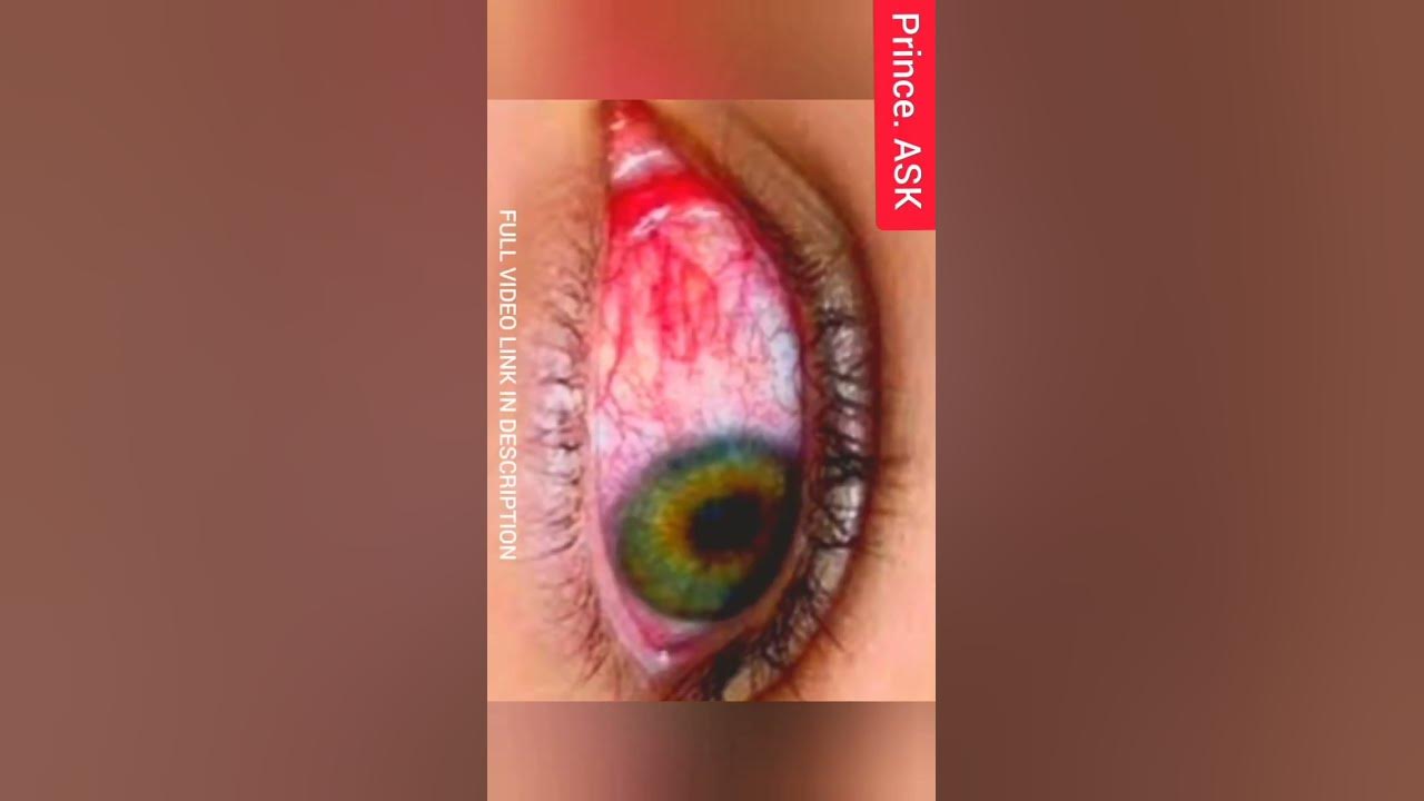 symptoms-of-madras-eye-in-tamil-how-to-cure-madras-eye-in-tamil