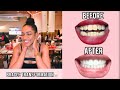 My Braces Transformation🦷 | 2 years in 10 mins