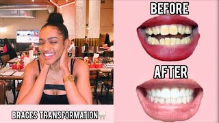 My Braces Transformation🦷 | 2 years in 10 mins