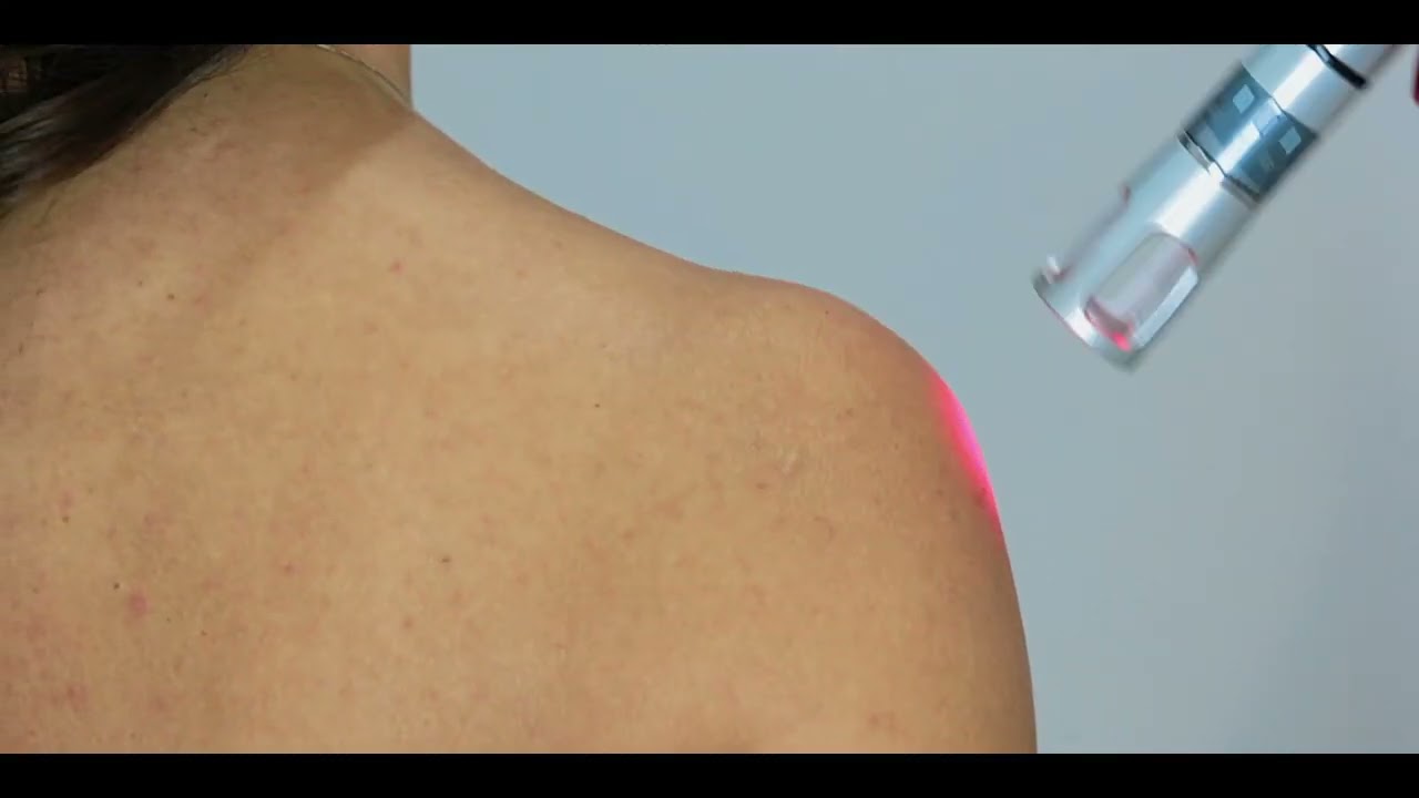 Fisioterapia Laser spalla