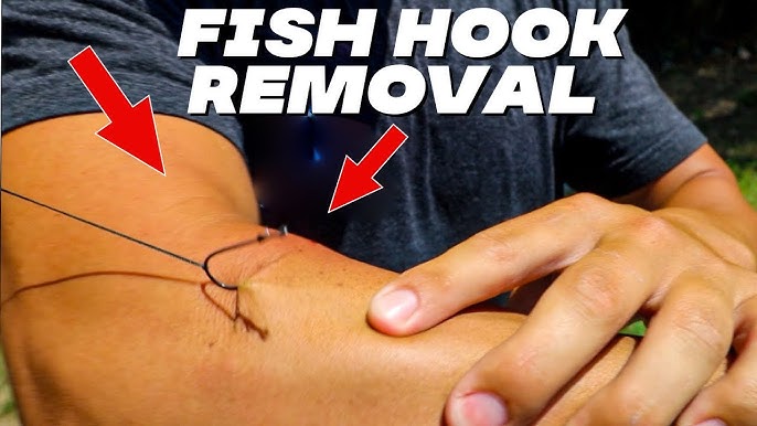 EASIEST HOOK REMOVAL TRICKI HOOKED MYSELF TO PROVE IT! ( How to remove a fish  hook ) 