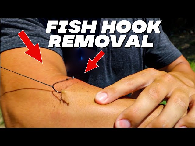 How to easily remove a hook from hand or body (painless method