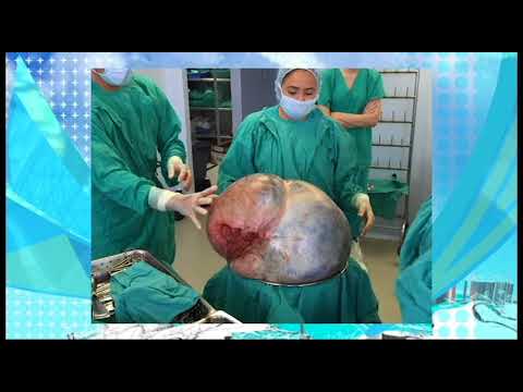 Vídeo: Cirujanos Estadounidenses Extirparon Un Tumor De Dos Kilogramos De La Boca De Una Mujer Haitiana - Vista Alternativa