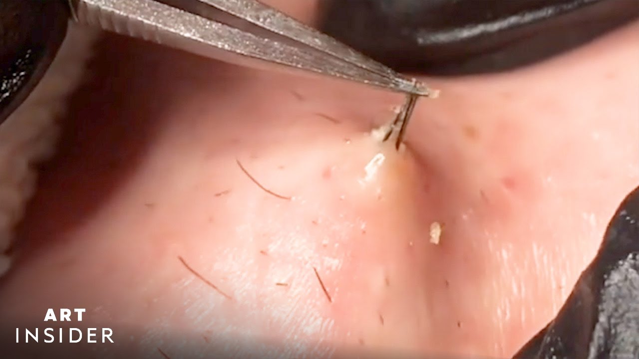 Huge ingrown toenail removal