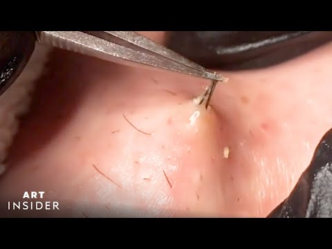 How Ingrown Hairs Are Removed