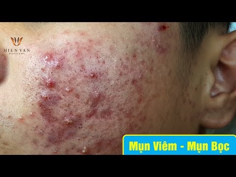 Video Cách điều trị mụn viêm, mụn bọc hiệu quả | Duy Phương... - youtube