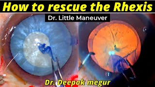 How To Rescue The Rhexis Dr Little Maneuver - Dr Deepak Megur