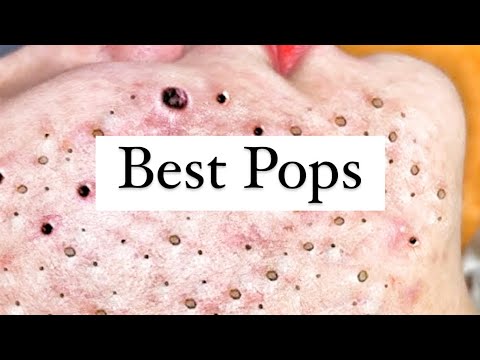 Pimple Popping History of Amazing Medical! Surgery & Medical Videos