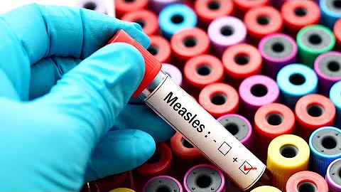 Measles on the rise across the U.S., 3 cases confirmed in Sacramento | Need to know