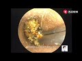 Treatment of earwax in children 11 minutes