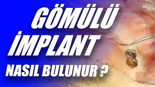 Gömülü İmplantların Yeri Nasıl Bulunur? İyileşme Başlığı Nasıl Takılır?