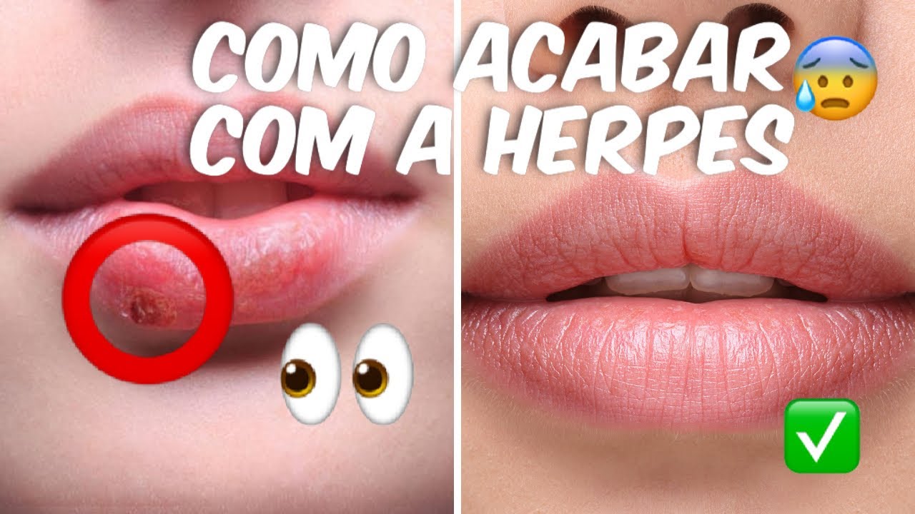 ESFREGUE ISSO NA SUA HERPES COM REMÉDIO CASEIRO E CURA NA HORA - YouTube