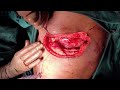 Open thoracotomy in Steps