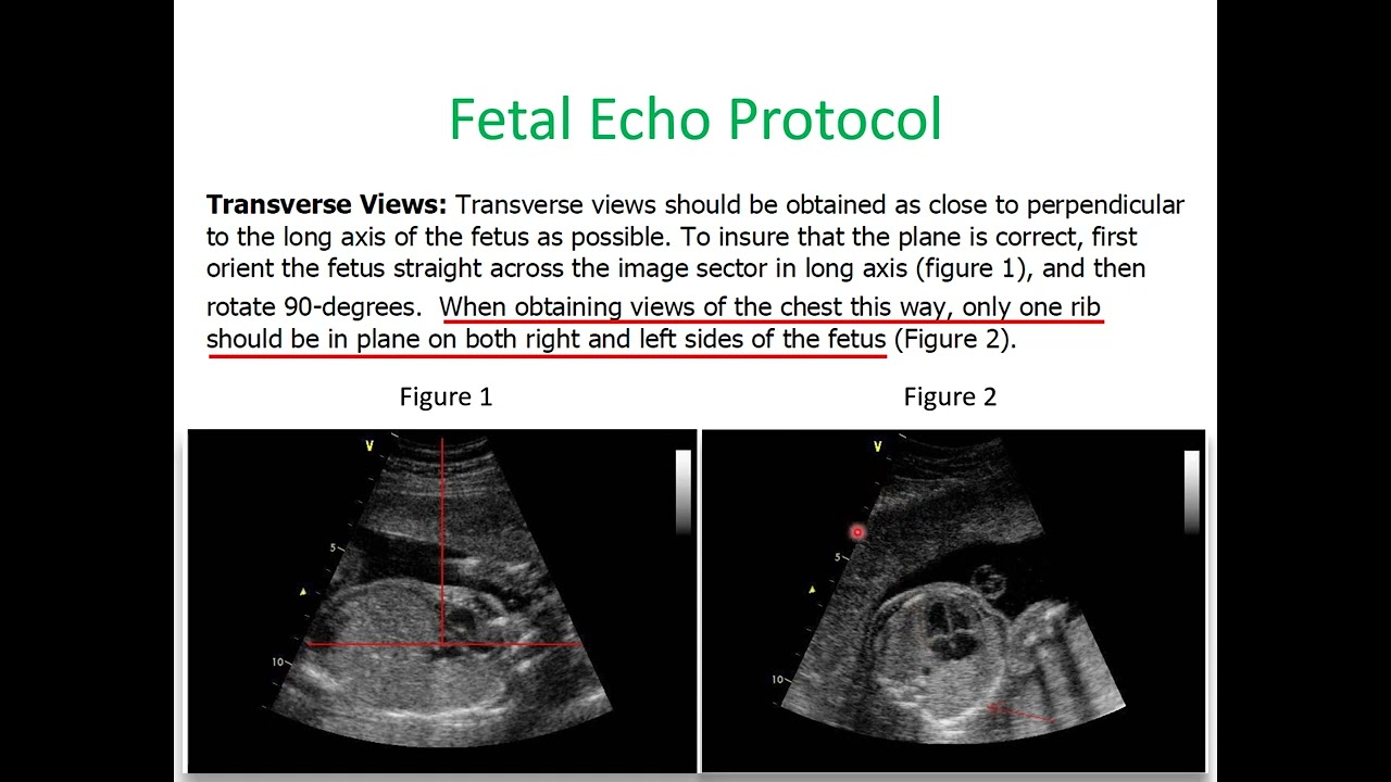 Basic Fetal Echo Protocol and Optimization 1