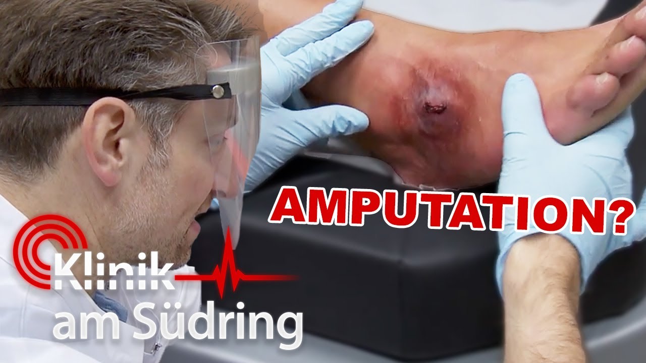 „Das sieht NICHT gut aus!“ Muss der Fuß amputiert werden? | Klinik am Südring | SAT.1