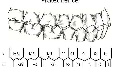 STATIC OCCLUSION - Occlusal Contacts & Picket Fence