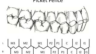 STATIC OCCLUSION - Occlusal Contacts & Picket Fence