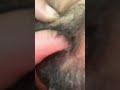 #ingrownhair #satisfying #asmrmassage #massagespa #viralvideo